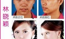 微整形隆鼻最新爆料,安全与美丽并存